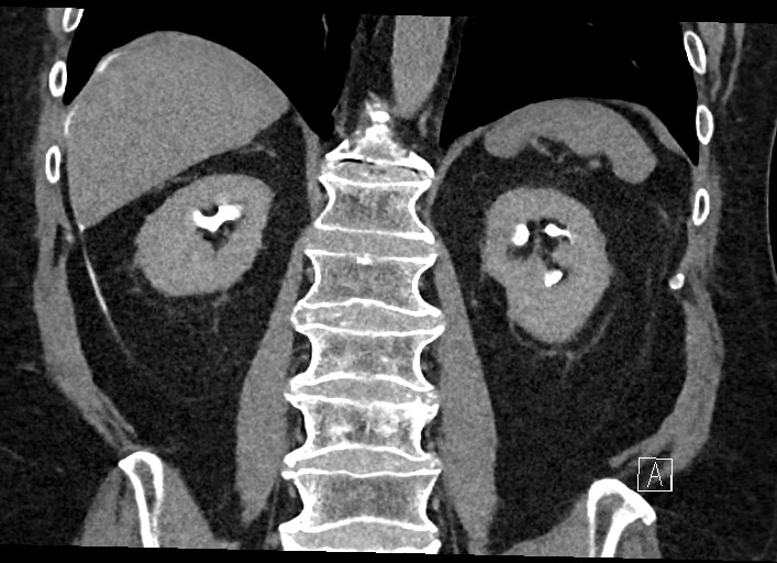 Buried bumper syndrome - gastrostomy tube (Radiopaedia 63843-72577 Coronal Inject 93).jpg