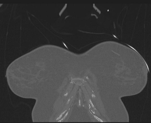 Burst fracture - thoracic spine (Radiopaedia 30238-30865 Coronal bone window 14).jpg