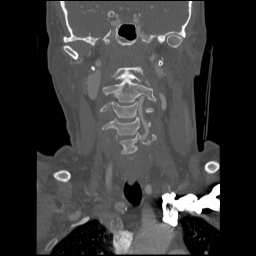C1 anterior arch (plough) fracture - type 1 (Radiopaedia 76181-87720 Coronal bone window 61).jpg