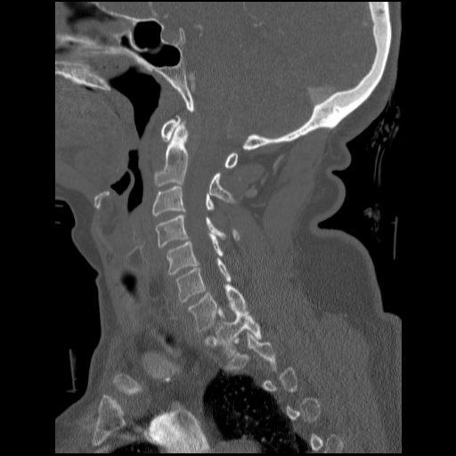 File:C1 anterior arch (plough) fracture - type 1 (Radiopaedia 76181-87720 Sagittal bone window 64).jpg