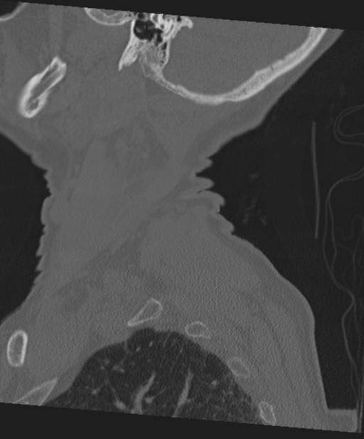 C2 fracture with vertebral artery dissection (Radiopaedia 37378-39199 Sagittal bone window 69).png