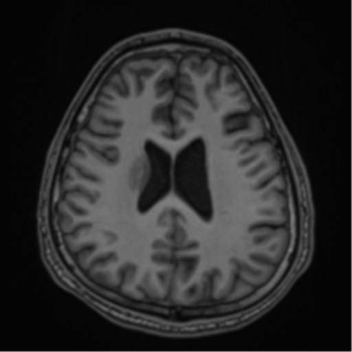 CNS vasculitis (Radiopaedia 55715-62263 Axial T1 55).png