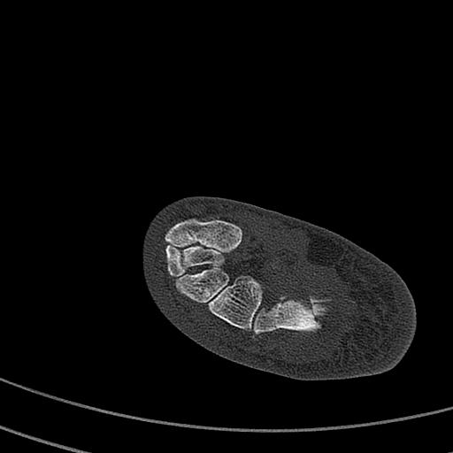 File:Calcaneal fracture - Sanders type 4 (Radiopaedia 90179-107370 Axial bone window 40).jpg