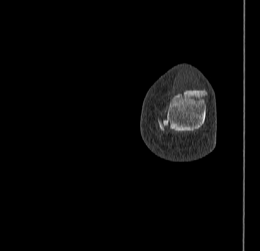 Calcaneal fracture - Sanders type 4 (Radiopaedia 90179-107370 Coronal bone window 90).jpg