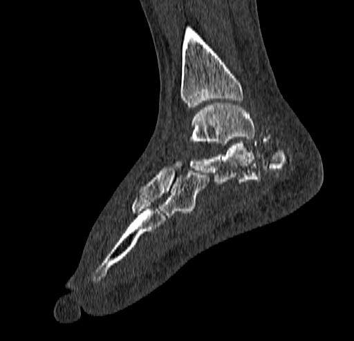 Calcaneal fracture - Sanders type 4 (Radiopaedia 90179-107370 Sagittal bone window 52).jpg