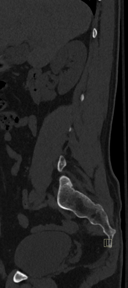 Calcaneal fractures with associated L2 burst fracture (Radiopaedia 71671-82493 Sagittal bone window 70).jpg