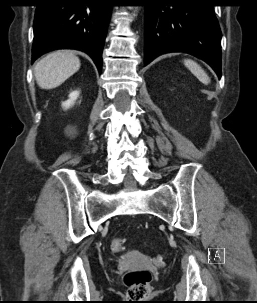Calcified adrenal glands and Spigelian hernia (Radiopaedia 49741-54988 B 86).jpg