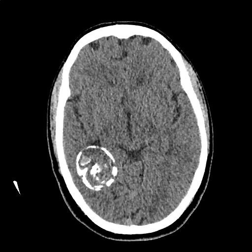 Calcified cerebral hydatid cyst (Radiopaedia 65603-74717 Axial non-contrast 31).jpg