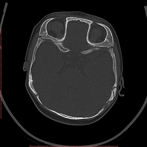 Calcified middle cerebral artery embolism (Radiopaedia 78949-91860 Axial bone window 13).jpg