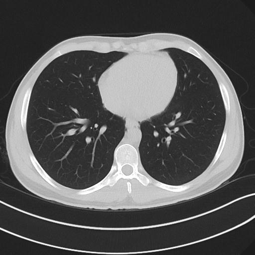 File:Cannabis ('bong') smoking induced pneumomediastinum and subcutaneous emphysema (Radiopaedia 29947-30479 C 53).jpg