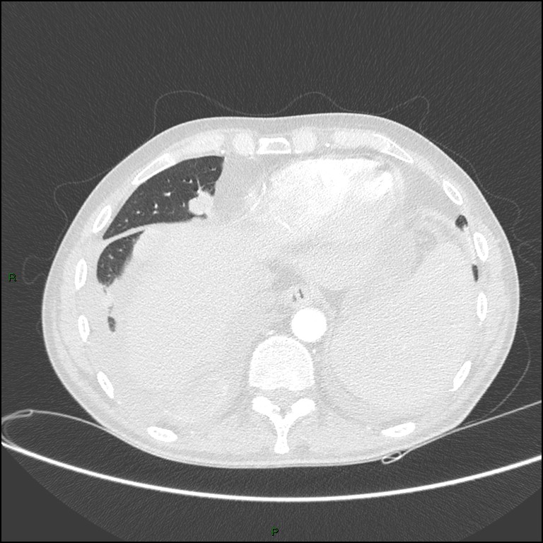 Cannonball metastases (Radiopaedia 82110-96150 Axial lung window 153).jpg