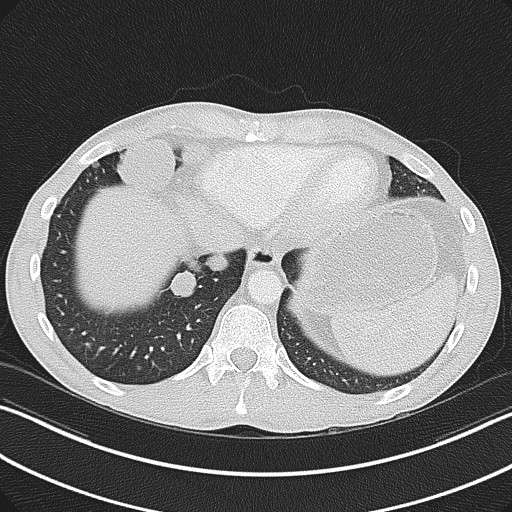 Cannonball metastases - testicular choriocarcinoma (Radiopaedia 84510-99891 Axial lung window 78).jpg