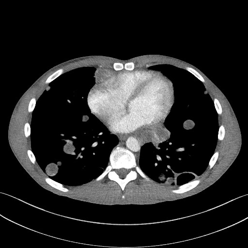 Cannonball metastases - testicular choriocarcinoma (Radiopaedia 84510-99891 B 74).jpg