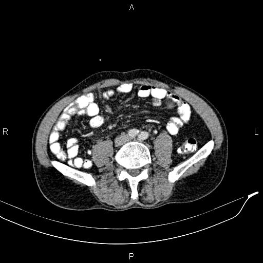 Caput medusae sign - portal hypertension (Radiopaedia 64007-72759 A 61).jpg