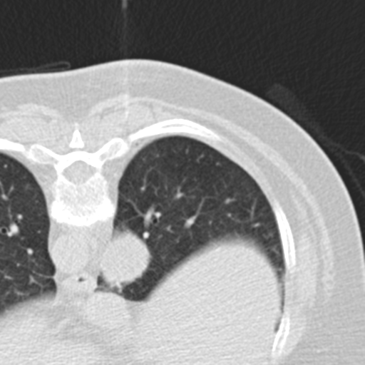 File:Carcinoid tumor - lung (Radiopaedia 44814-48644 Axial lung window 41).png