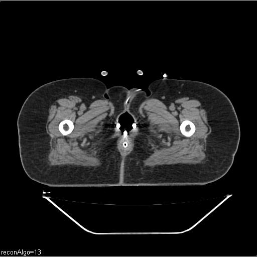 Carcinoma cervix- brachytherapy applicator (Radiopaedia 33135-34173 Axial non-contrast 56).jpg