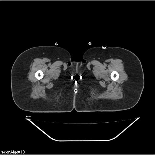 Carcinoma cervix- brachytherapy applicator (Radiopaedia 33135-34173 Axial non-contrast 63).jpg