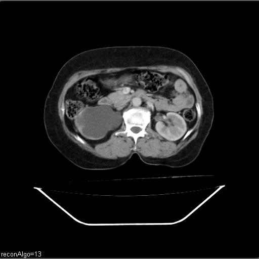 Carcinoma cervix- recurrence (Radiopaedia 34702-36137 B 21).jpg