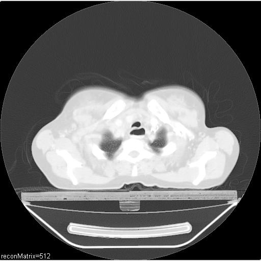 File:Carcinoma of esophagus (Radiopaedia 27356-27550 Axial lung window 29).jpg