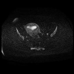 Carcinoma of the cervix (Radiopaedia 89018-105858 Axial DWI 57).jpg