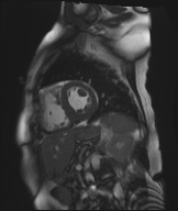 File:Cardiac amyloidosis (Radiopaedia 51404-57150 Sagittal CINE SSFP 168).jpg