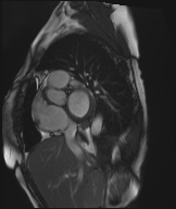 Cardiac amyloidosis (Radiopaedia 51404-57150 Sagittal CINE SSFP 276).jpg