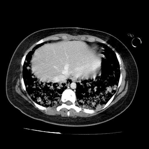 File:Cardiac angiosarcoma (Radiopaedia 66010-75181 B 72).jpg