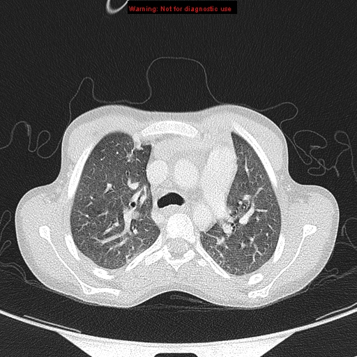 File:Cardiac bronchus (Radiopaedia 14059-13899 A 4).jpg