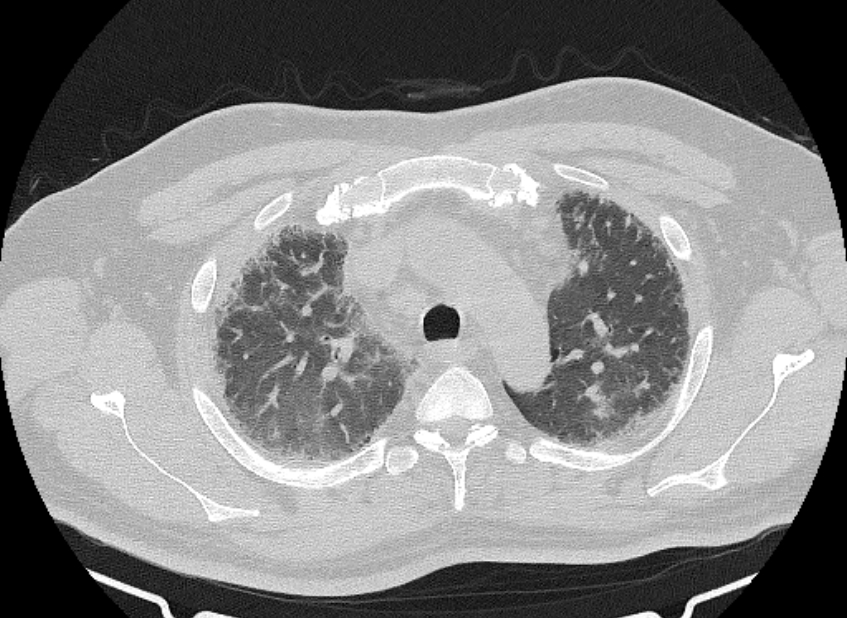 Cardiogenic pulmonary edema (Radiopaedia 68180-77678 Axial lung window 19).jpg