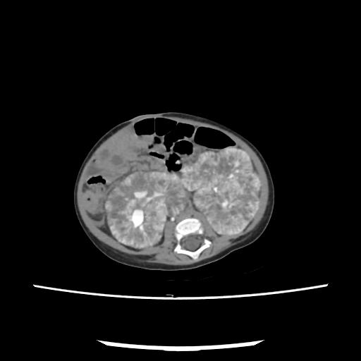 Caroli disease with autosomal recessive polycystic kidney disease (ARPKD) (Radiopaedia 89651-106703 E 143).jpg