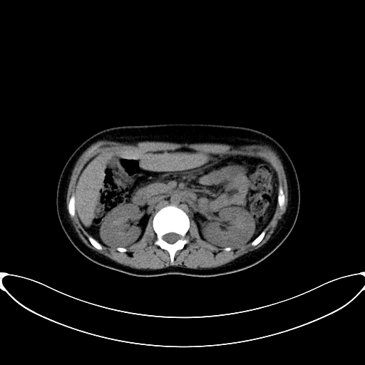 Caroli disease with medullary sponge kidney (Radiopaedia 82622-96804 Axial non-contrast 28).jpg