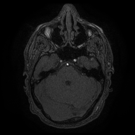 File:Carotid arterial dissection with acute cerebral infarction (Radiopaedia 26636-26784 MRA 125).jpg