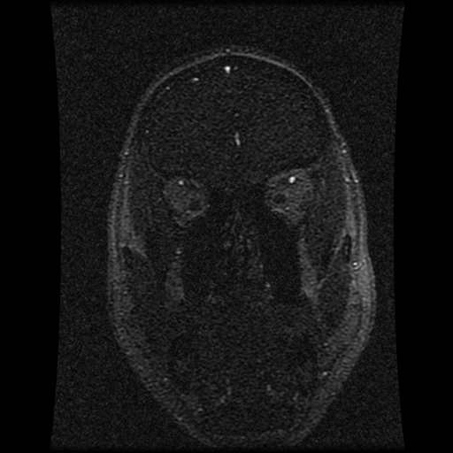 Carotid arterial dissection with acute cerebral infarction (Radiopaedia 26636-26784 MRV 128).jpg