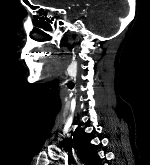 File:Carotid body tumor (Radiopaedia 39845-42300 D 52).jpg