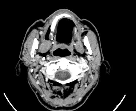 Carotid body tumor (Radiopaedia 61750-69757 Axial Post contrast 11).jpg