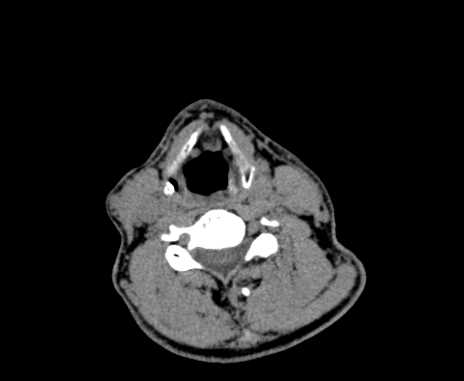 File:Carotid body tumor (Radiopaedia 61750-69757 Axial non-contrast 67).jpg