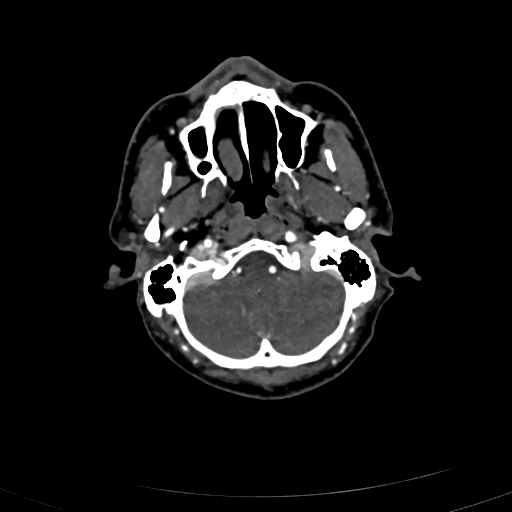 File:Carotid body tumor (Radiopaedia 83615-98727 A 26).jpg