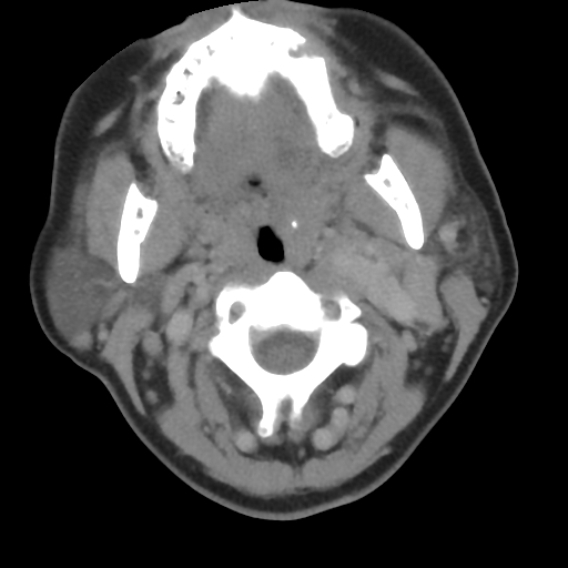 Carotid body tumor (paraganglioma) (Radiopaedia 38586-40729 A 48).jpg