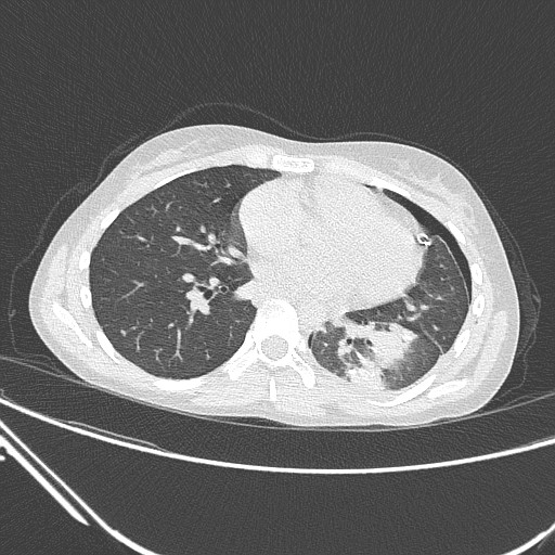 Catamenial pneumothorax (Radiopaedia 27946-28197 lung window 96).jpg