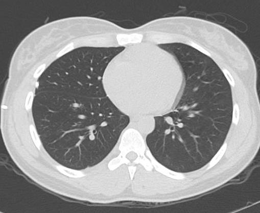 File:Catamenial pneumothorax (Radiopaedia 54382-60600 Axial 32).png