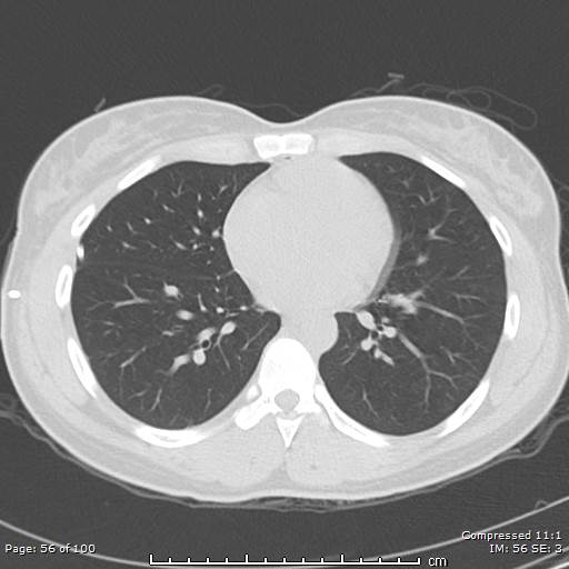 File:Catamenial pneumothorax (Radiopaedia 54382-60600 Axial non-contrast 56).jpg