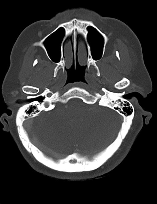 Causes of dysphagia (Radiopaedia 40149-42657 Axial bone window 8).png