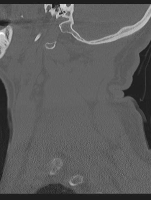 Cavernoma of cervical cord (Radiopaedia 50838-56346 Sagittal bone window 15).png