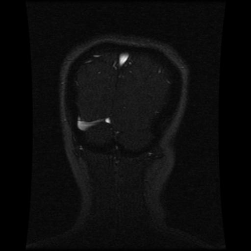 Cavernoma with developmental venous anomaly (Radiopaedia 22470-22507 MRV 31).jpg