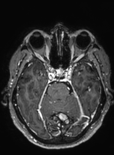 Cavernous hemangioma of the cerebellar falx (Radiopaedia 73025-83724 Axial T1 C+ 227).jpg