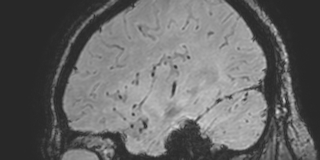 Cavernous hemangioma of the cerebellar falx (Radiopaedia 73025-83724 Sagittal BOLD 47).jpg