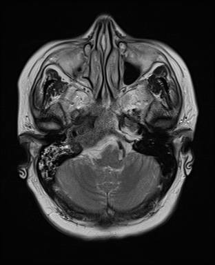 File:Cavernous sinus meningioma (Radiopaedia 63682-72367 Axial T2 5).jpg