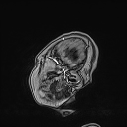 Cavernous sinus meningioma (Radiopaedia 63682-72367 Sagittal T1 C+ 23).jpg