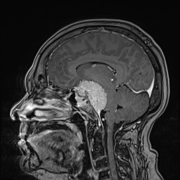 Cavernous sinus meningioma (Radiopaedia 63682-72367 Sagittal T1 C+ 86).jpg