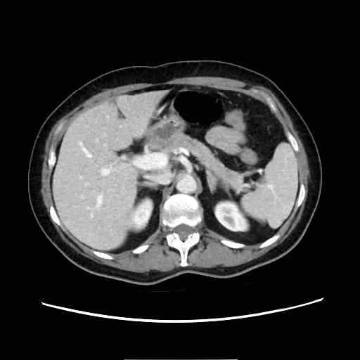 Cecal adenocarcinoma (Radiopaedia 75909-87331 A 29).jpg